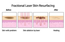 FRAXEL Laser Skin Resurfacing