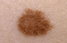 Scar Revision