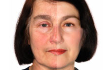 Intense Pulsed Light