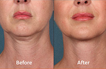 Kybella