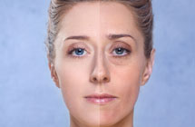Skin Peels