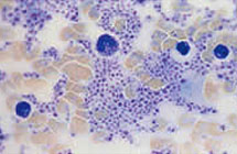 Platelet Rich Plasma
